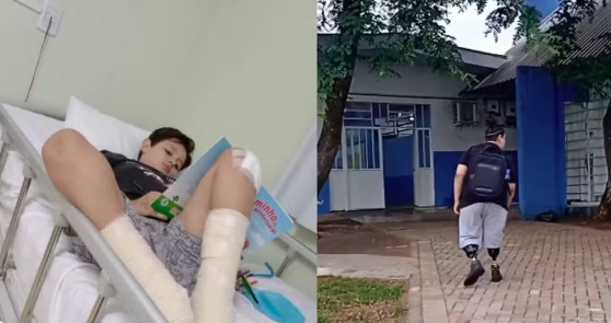 Criança de 10 anos teve as pernas amputadas após acidente com skate